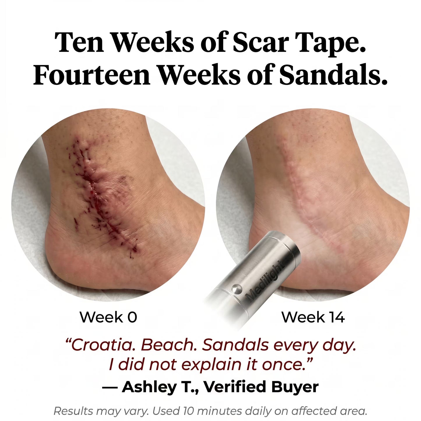 MediLight Deep Impulse — Post-Surgical Scar Recovery